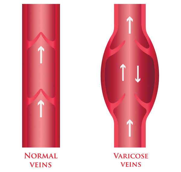 What Are Varicose Veins? What Causes and Prevents Them?